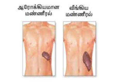 மண்ணீரல் வீக்கம்.