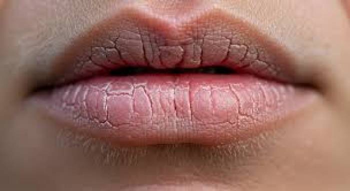 உதடு வெடிப்புக்கு.....