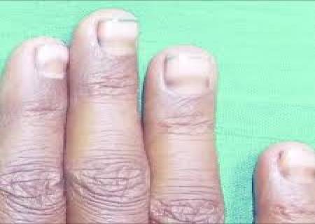 நகத்தின் கருமை மறைய...