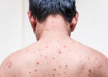  தமிழகத்தில் சின்னம்மை பாதிப்பு