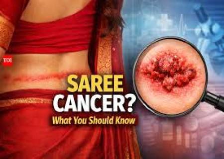 பெண்களை தாக்கும் saree cancer.