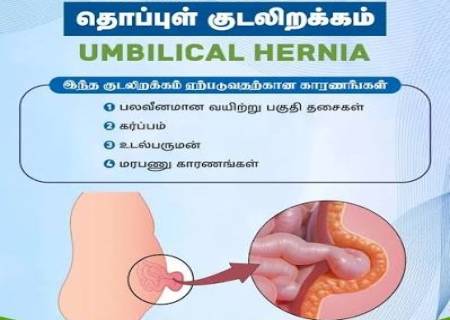தொப்புள் குடலிறக்கம் என்றால் என்ன?