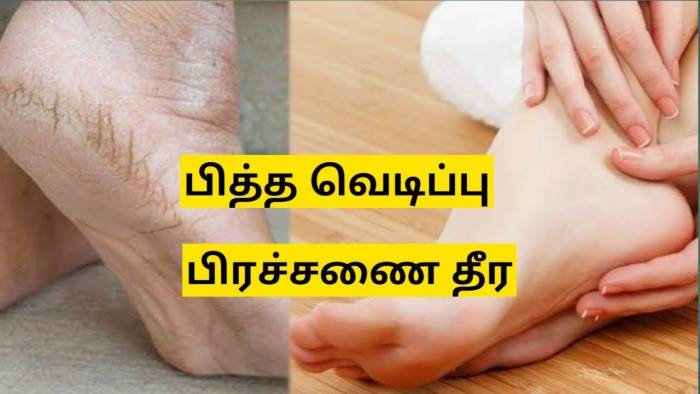 பித்த வெடிப்பு குணமாக...