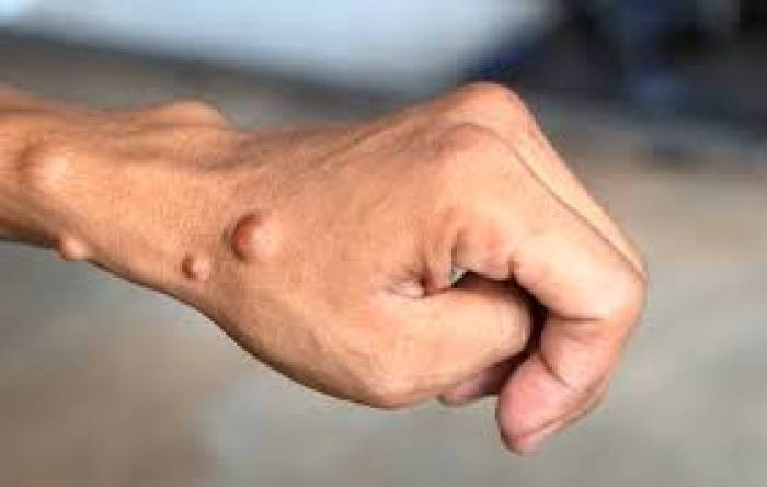 நியூரோவைப்ரோமெட்டோசில். (Neurofibrometosis)