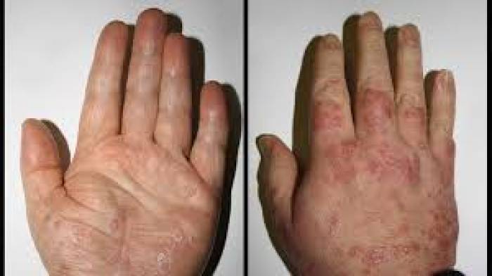 சொரியாஸிஸ் ( Psoriasis )