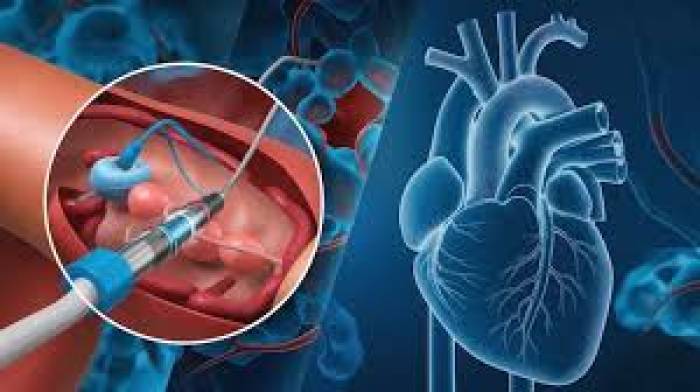 இதய அறுவை சிகிச்சையின் நன்மைகள்.