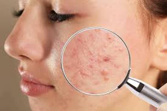 முகத்தில் பரு நீங்க …..